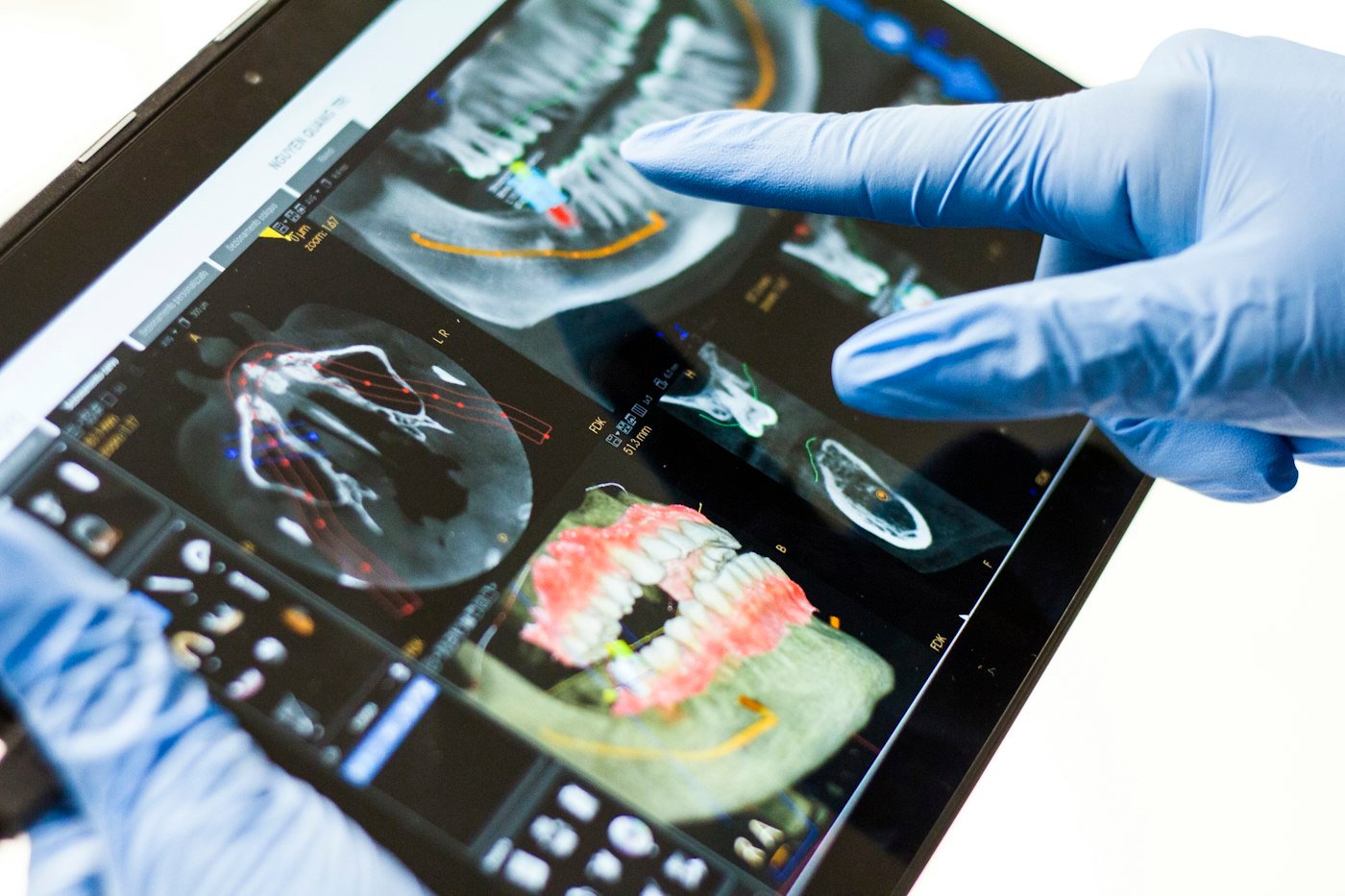Dentist reviewing a 3D dental scan on a tablet to plan implants