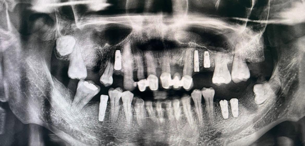 Panoramic X-ray showing multiple dental implants