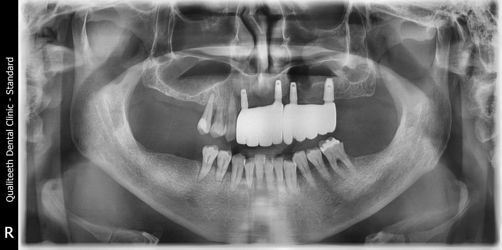 Panoramic X-ray of an implant-supported bridge