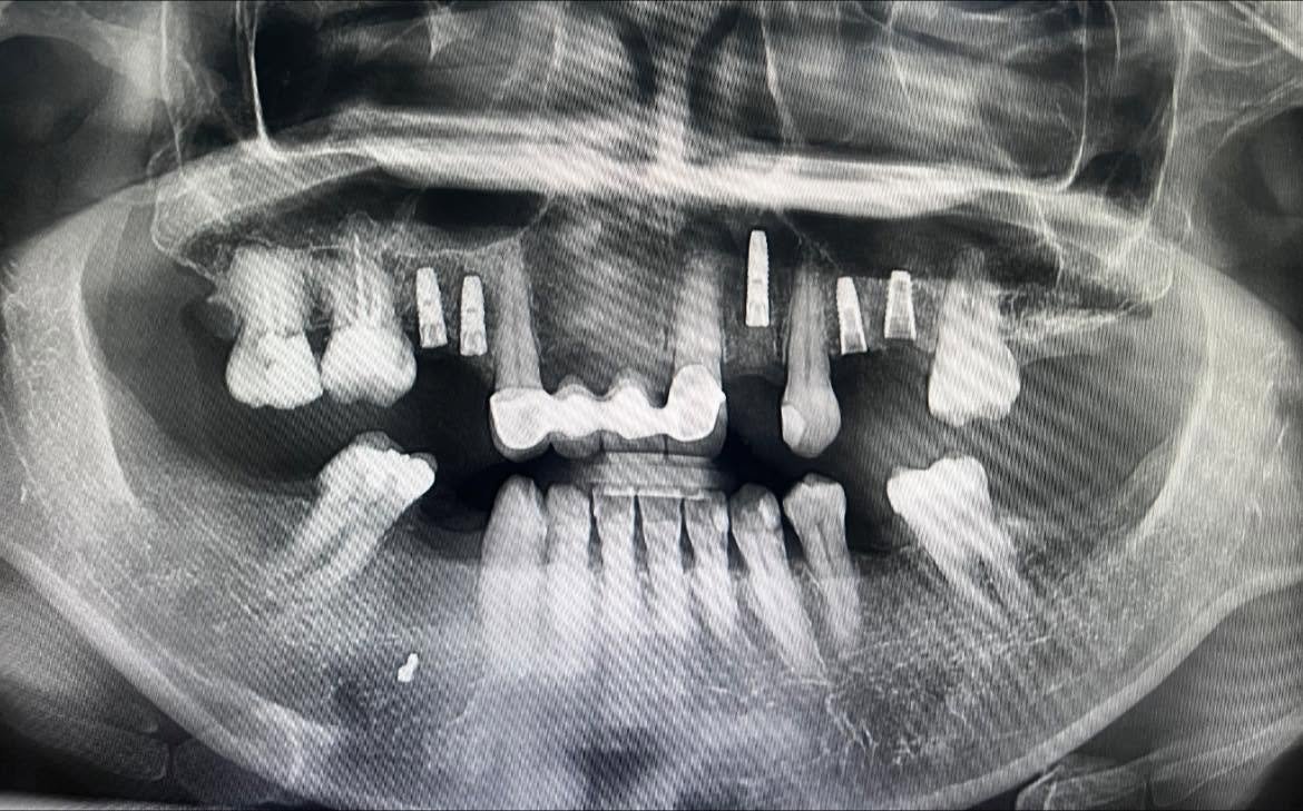 Panoramic X-ray before dental implant treatment