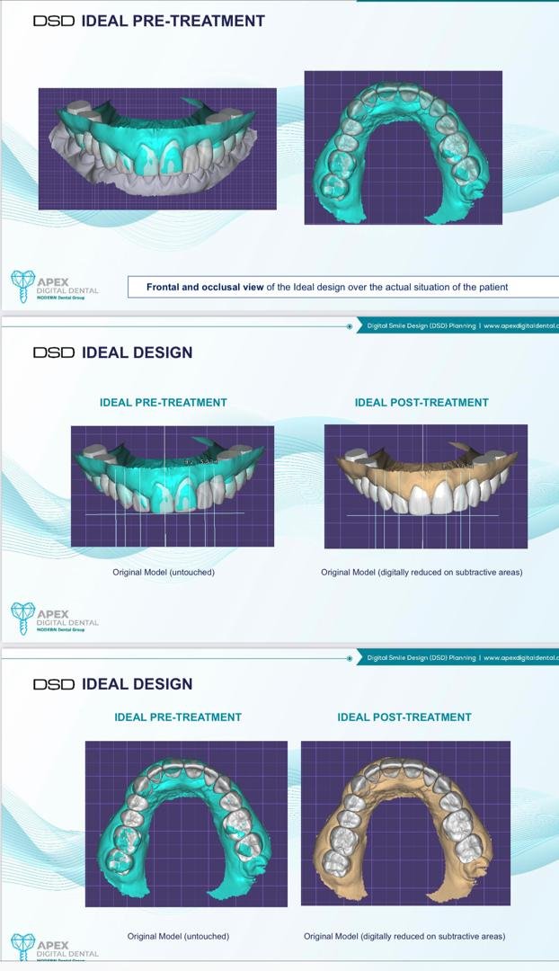 Digital smile design (DSD) 3D plan of the ideal pre-treatment and post-treatment smile