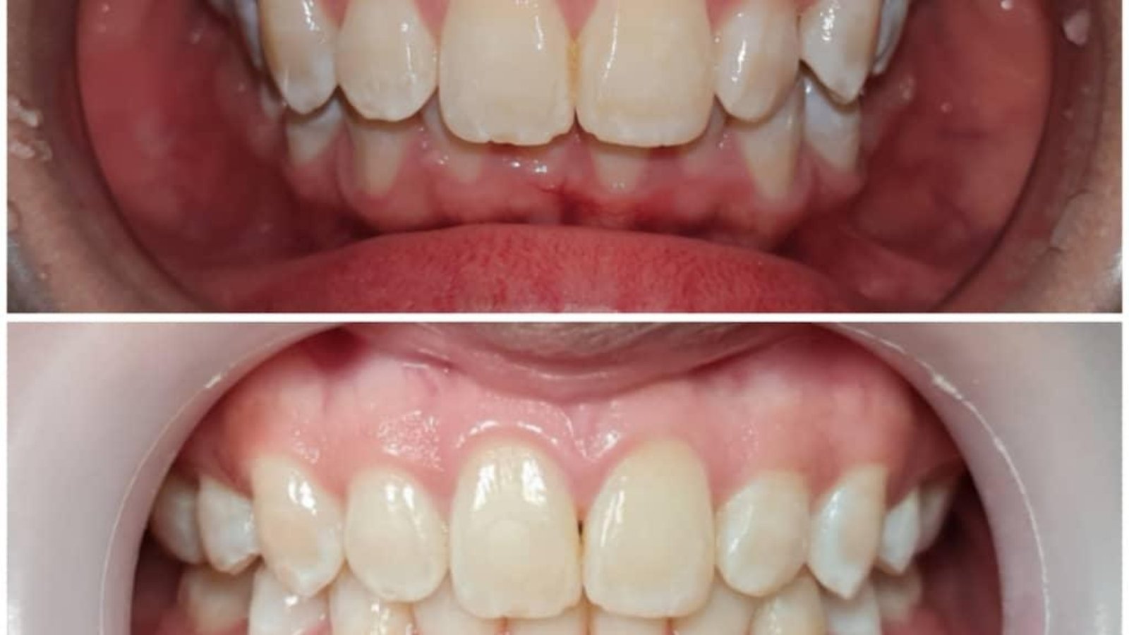 Braces / clear aligner before and after at Qualiteeth: straighter smile