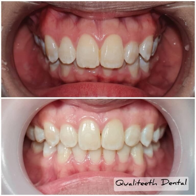 Braces / clear aligner before and after at Qualiteeth: straighter smile