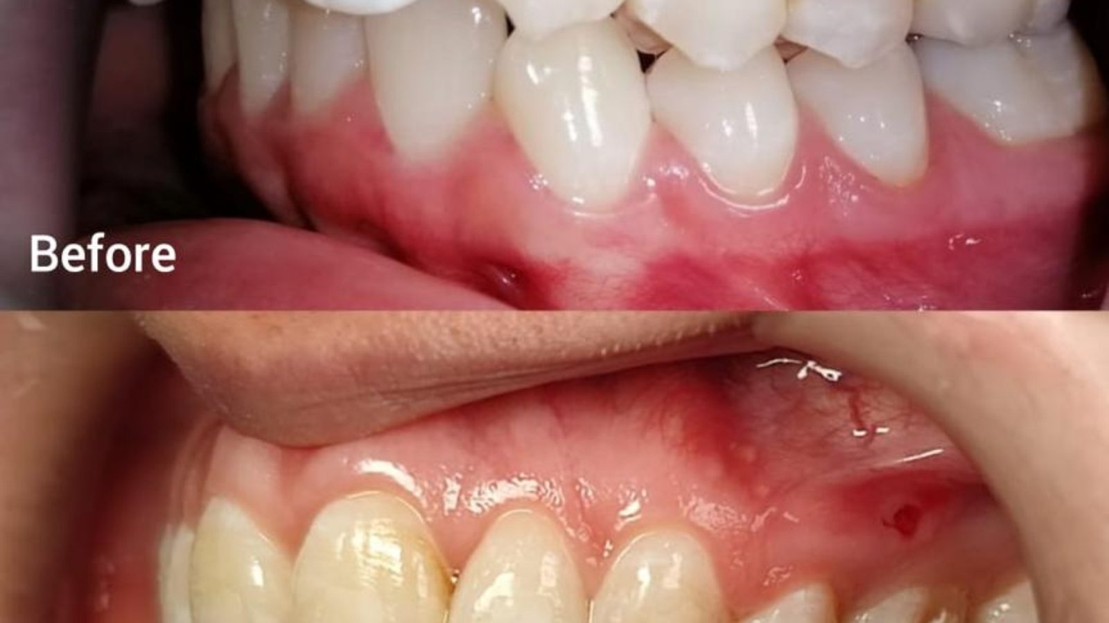 Braces / clear aligner before and after at Qualiteeth: protruding teeth aligned