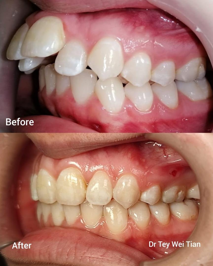 Braces in cheras: Braces before and after at Qualiteeth: protruding front teeth aligned
