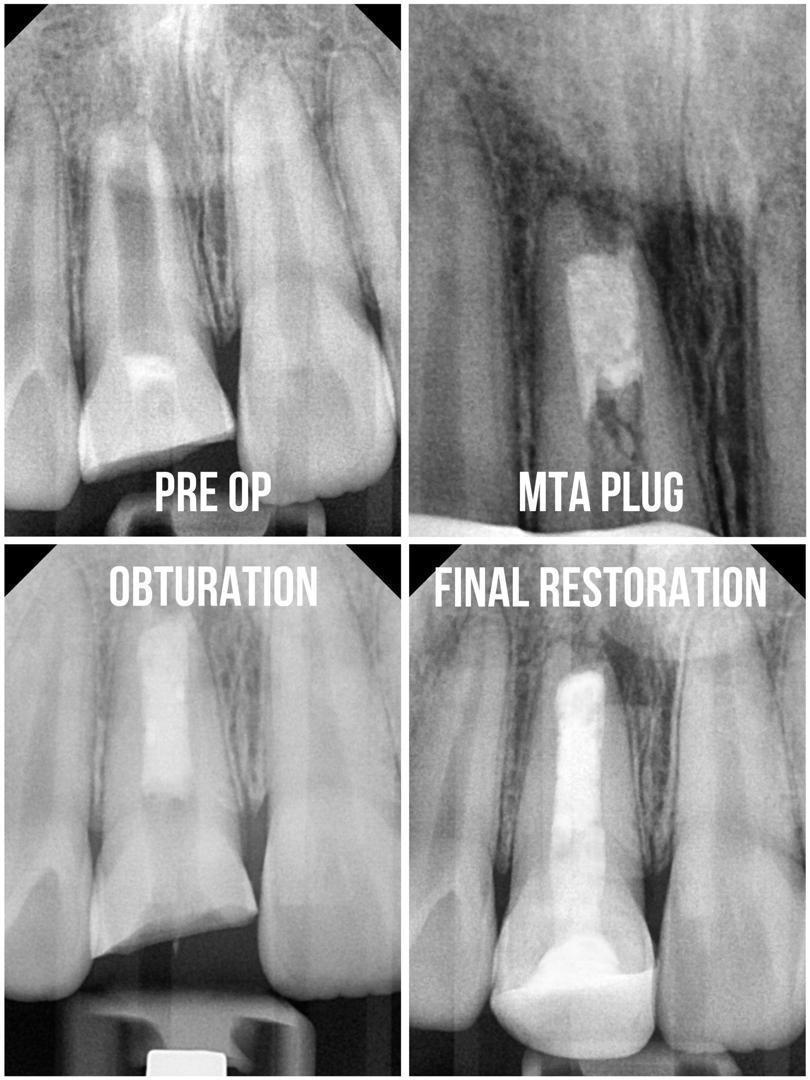 X-ray series of root canal treatment: pre-op, MTA plug, obturation and final restoration