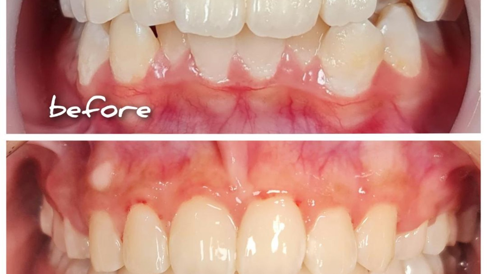 Braces / clear aligner before and after at Qualiteeth: crooked teeth straightened
