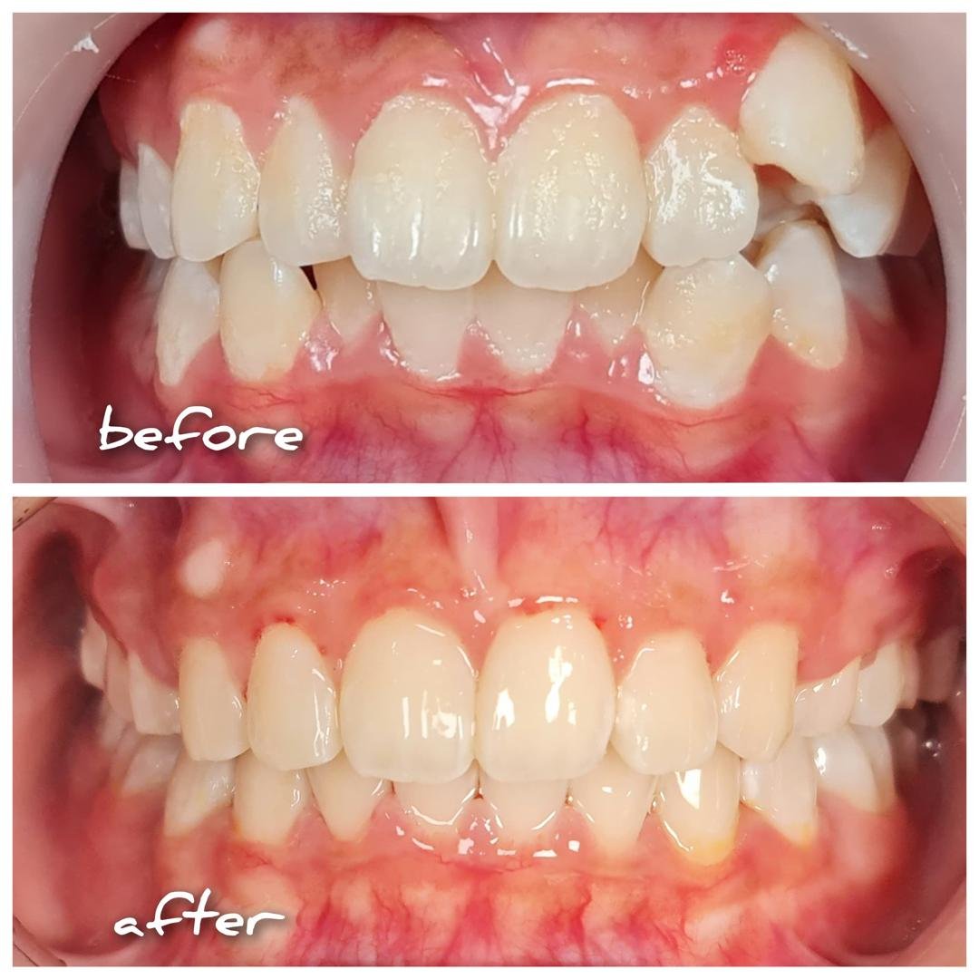Braces before and after at Qualiteeth: crooked teeth straightened