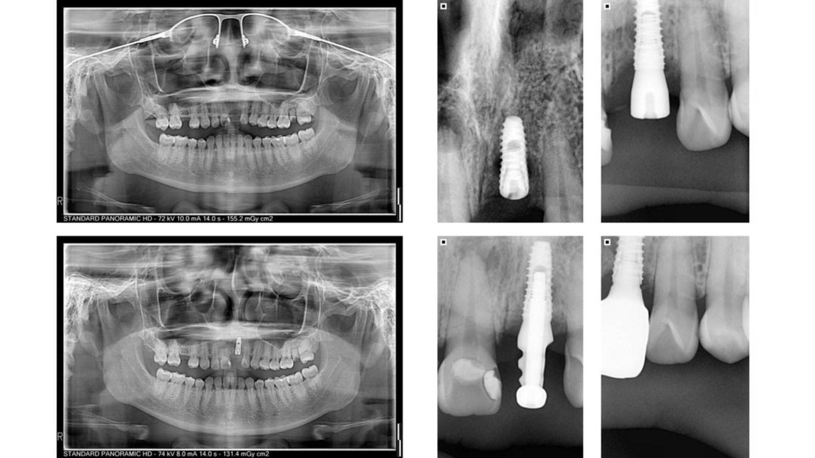 X-ray series of a single dental implant from placement to crown