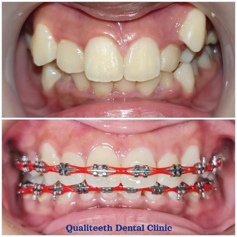 Patient wearing braces at Qualiteeth, before and during treatment