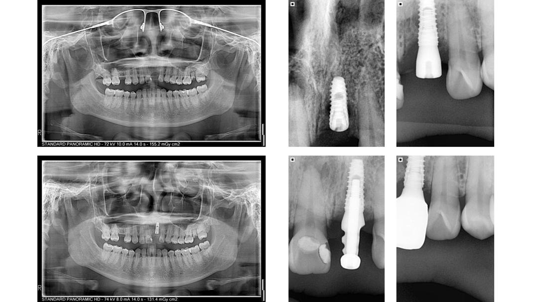 Implan gigi: X-ray series of a single dental implant from placement to crown