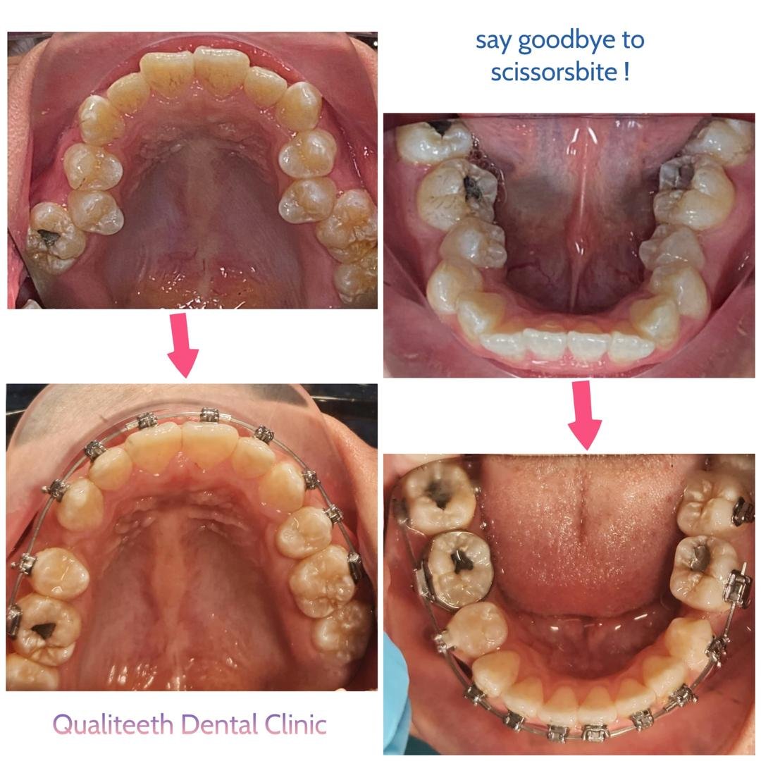 Qualiteeth 箍牙前后对比:交叉咬合得到矫正