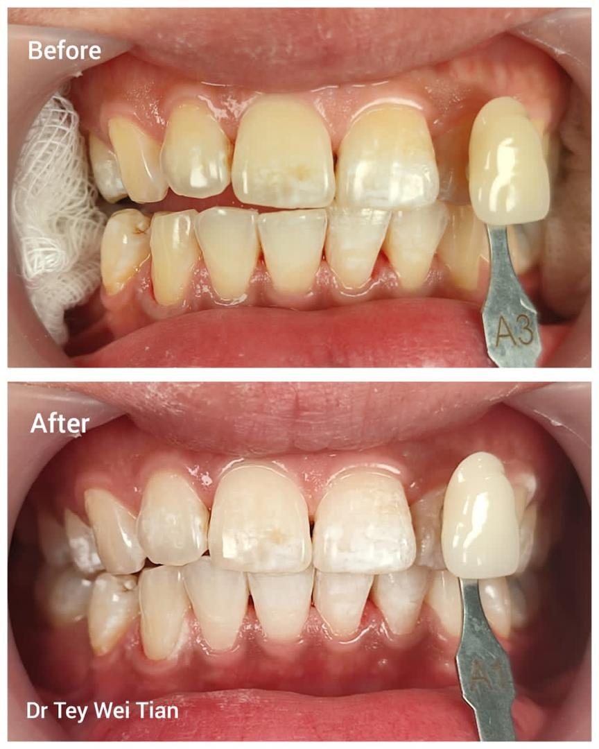 Teeth whitening before and after with shade guide