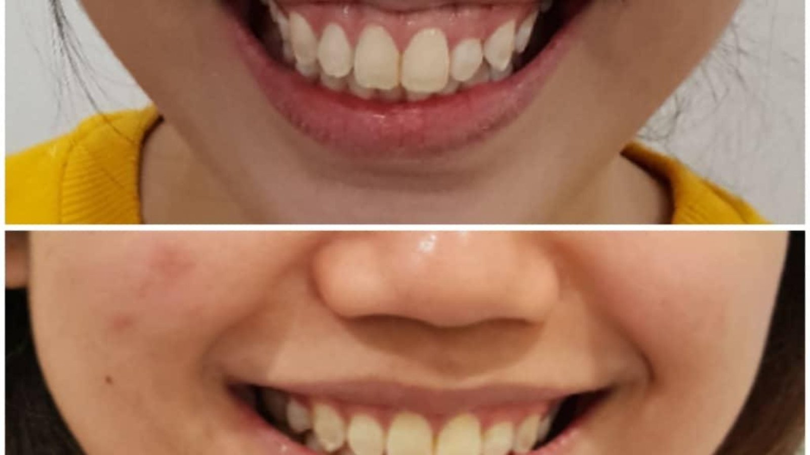 Braces / clear aligner before and after at Qualiteeth: straighter, more even smile