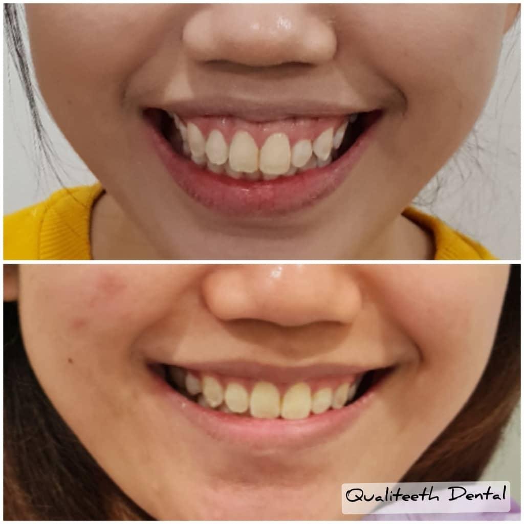 Pasang braces di petaling jaya: Sebelum dan selepas braces di Qualiteeth: senyuman lebih tersusun