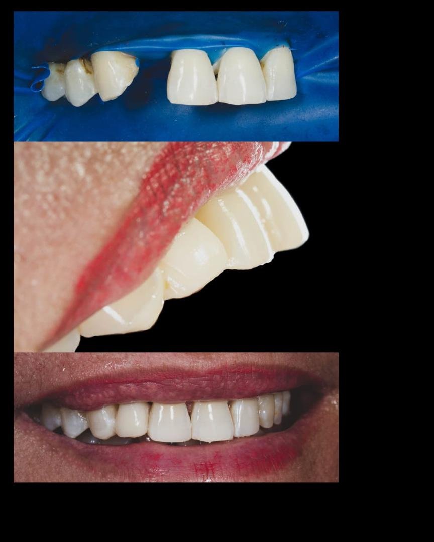 Aesthetic tooth-coloured fillings on front teeth, placed under rubber dam