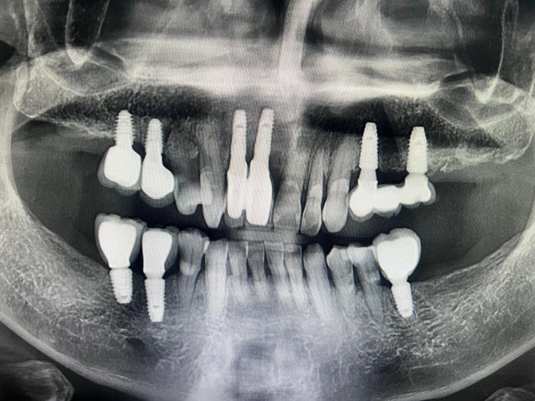 Panoramic X-ray of full-mouth dental implant restoration