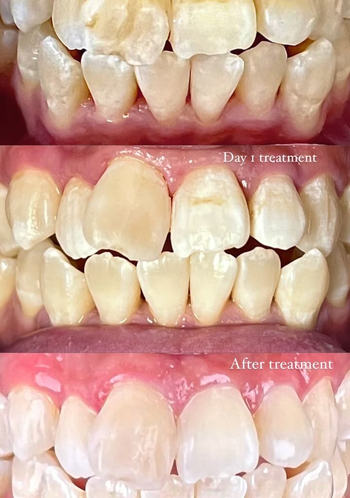 Icon resin infiltration on discoloured front teeth: before, day 1 and after treatment at Qualiteeth