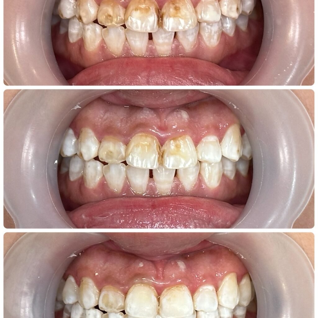 Icon resin infiltration for fluorosis stains on front teeth, before, during and after treatment at Qualiteeth