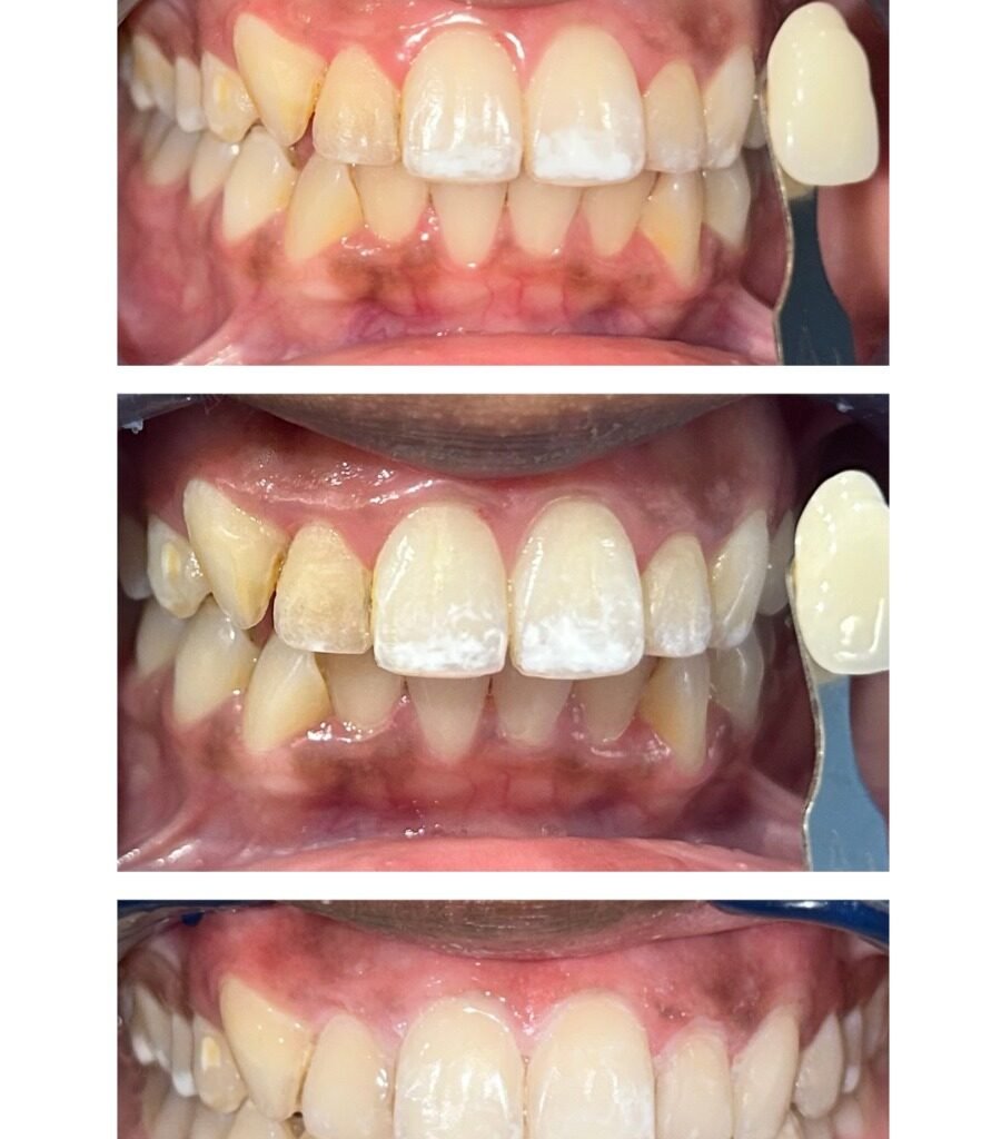 Icon resin infiltration on upper front teeth: white spots before, during and after treatment at Qualiteeth