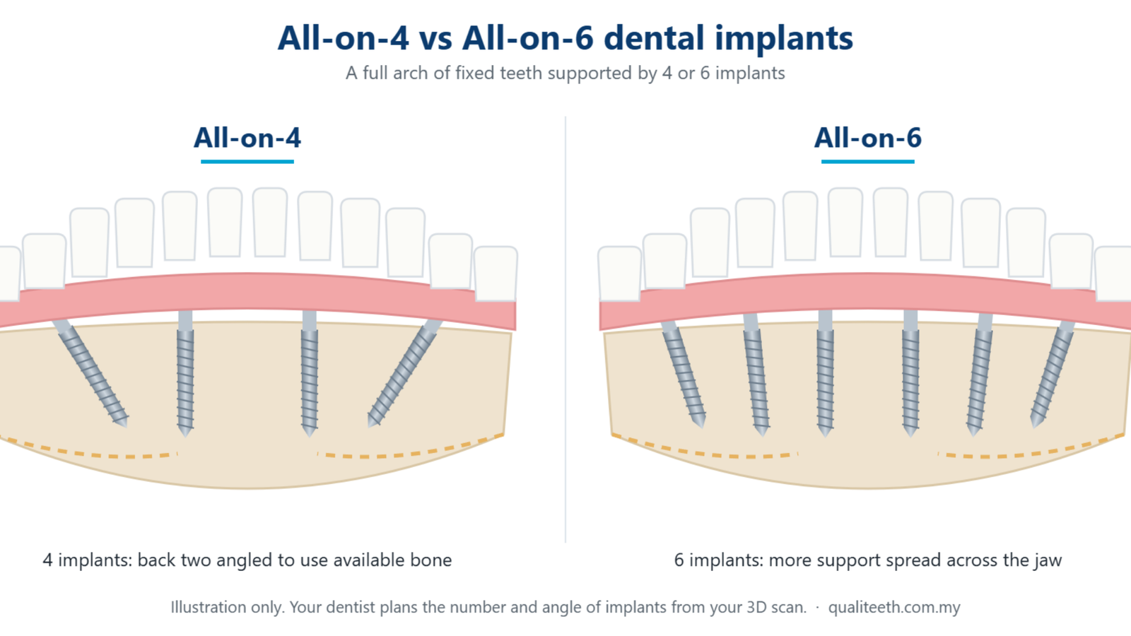Diagram comparing All-on-4 and All-on-6 dental implants supporting a full arch of fixed teeth