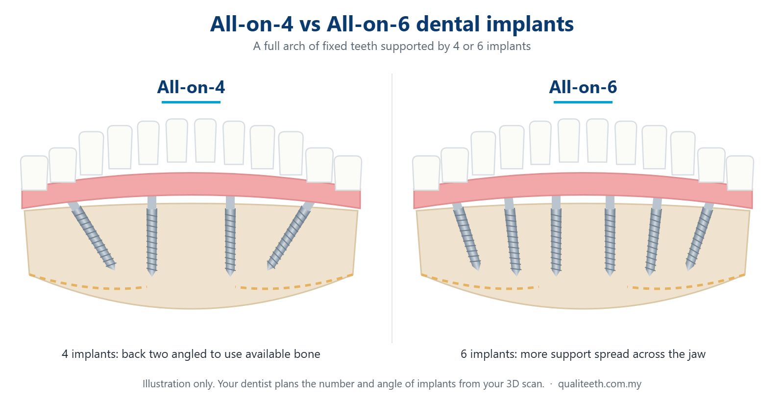 Diagram comparing All-on-4 and All-on-6 dental implants supporting a full arch of fixed teeth
