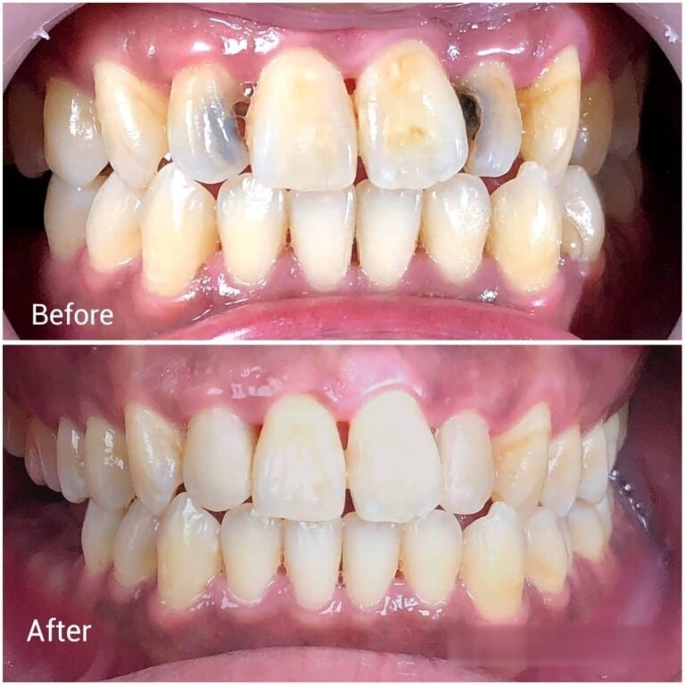 Aesthetic tooth-coloured fillings before and after: decayed and discoloured front teeth restored