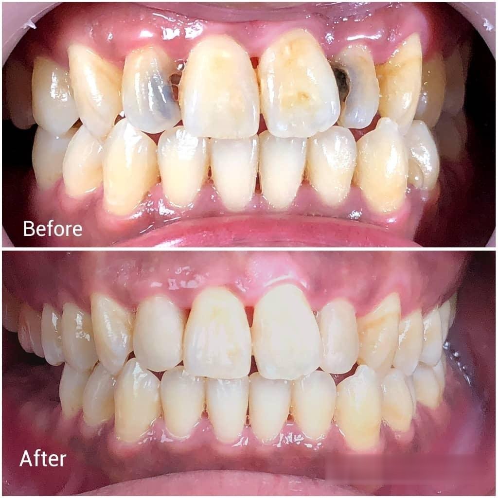 Aesthetic tooth-coloured fillings before and after