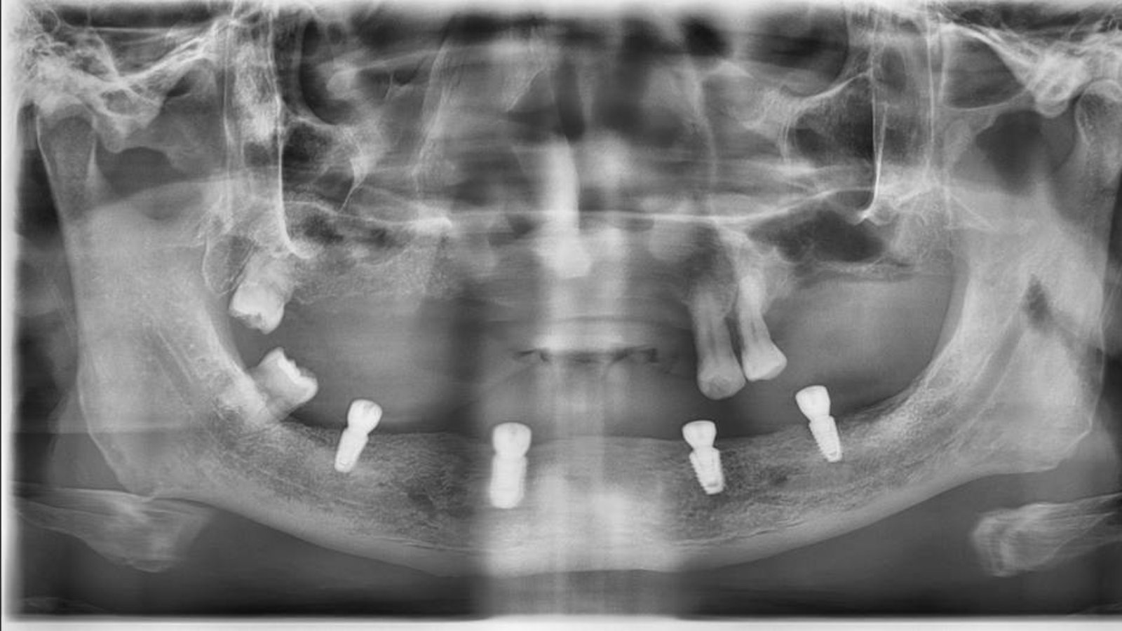 Panoramic X-ray of a Qualiteeth patient showing four dental implants placed in the lower jaw for an All-on-4 full arch