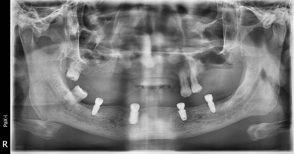 Harga implan gigi: X-ray panoramik empat implan gigi di rahang bawah untuk All-on-4 di Qualiteeth