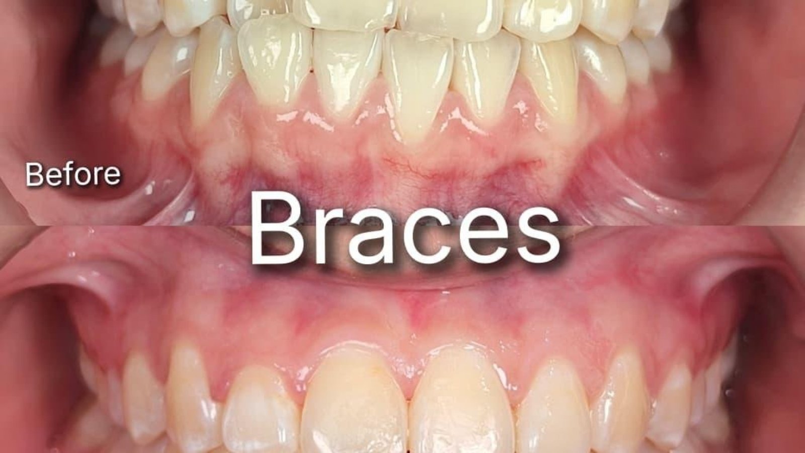 Braces / clear aligner before and after at Qualiteeth: uneven bite corrected
