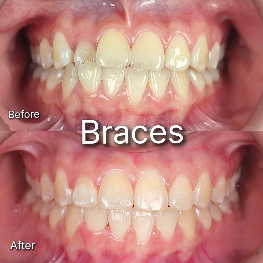 Braces before and after at Qualiteeth: uneven bite corrected