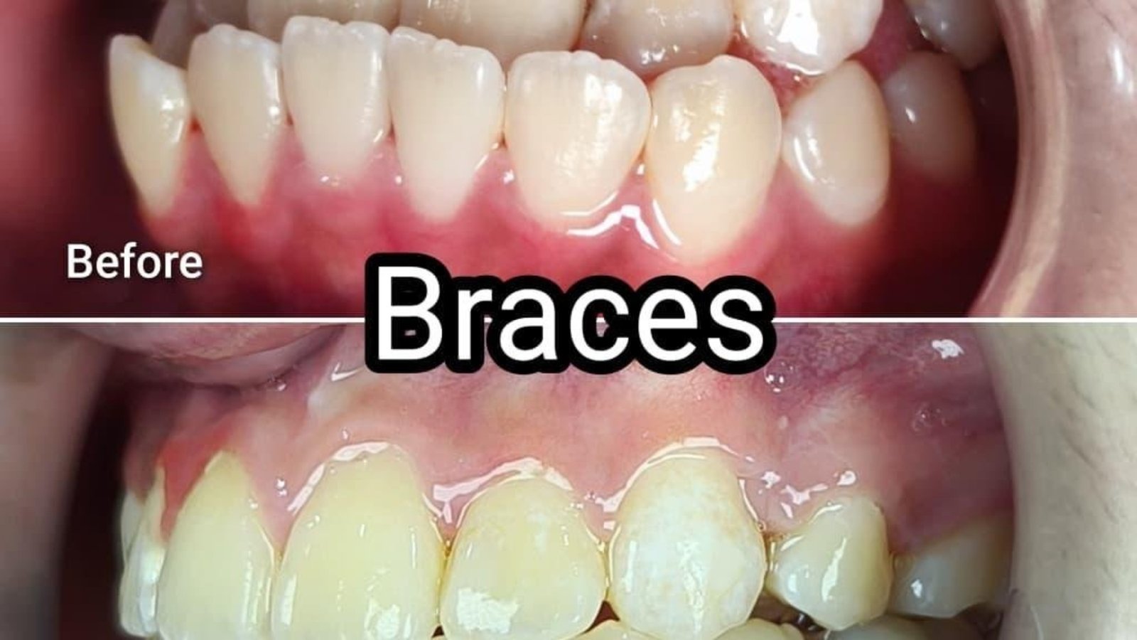 Braces / clear aligner before and after at Qualiteeth: crowded teeth straightened