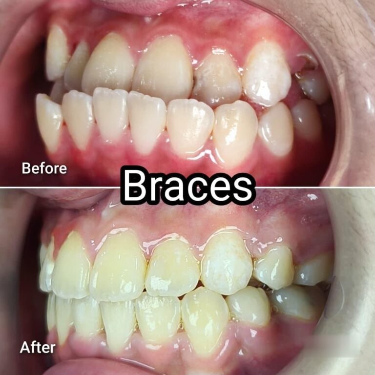 Braces / clear aligner before and after at Qualiteeth: crowded teeth straightened