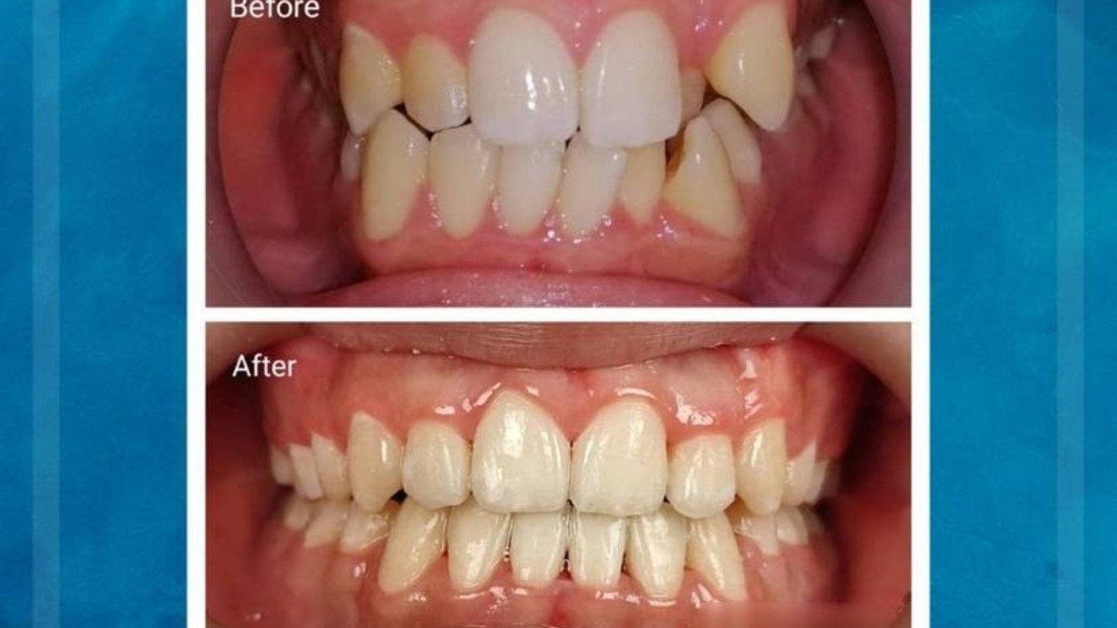 Braces / clear aligner before and after at Qualiteeth: crooked teeth straightened (绑牙前后)