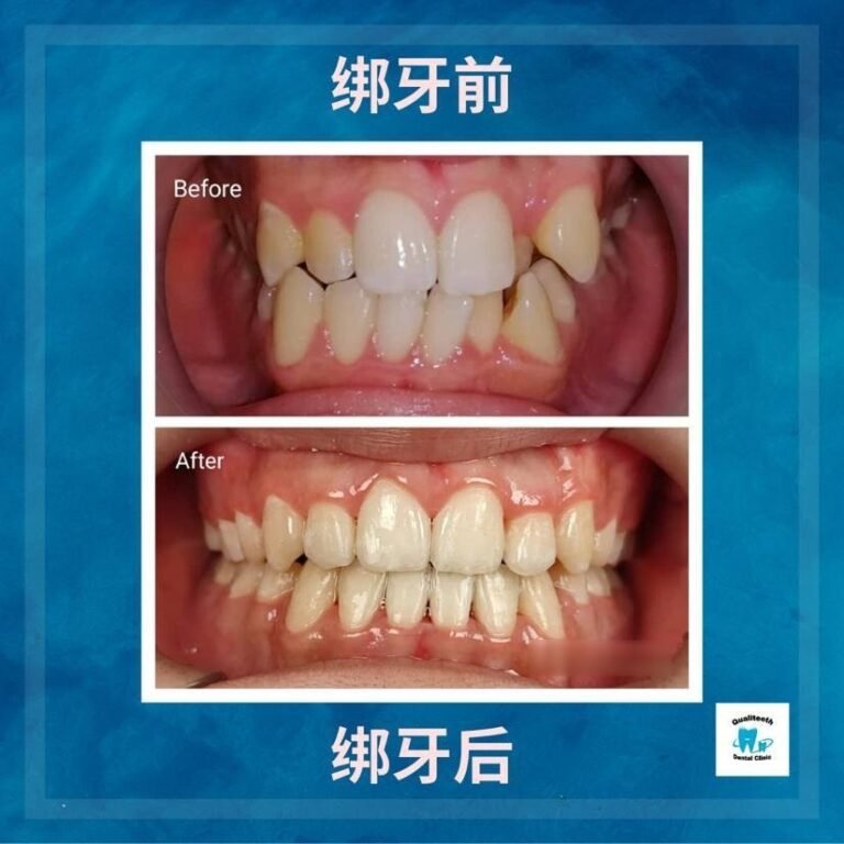 Braces / clear aligner before and after at Qualiteeth: crooked teeth straightened (绑牙前后)