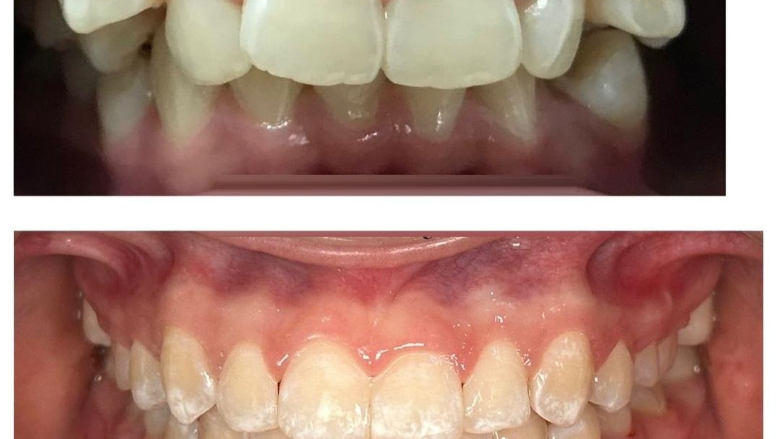 Braces / clear aligner before and after at Qualiteeth: crowded teeth aligned into a straight smile
