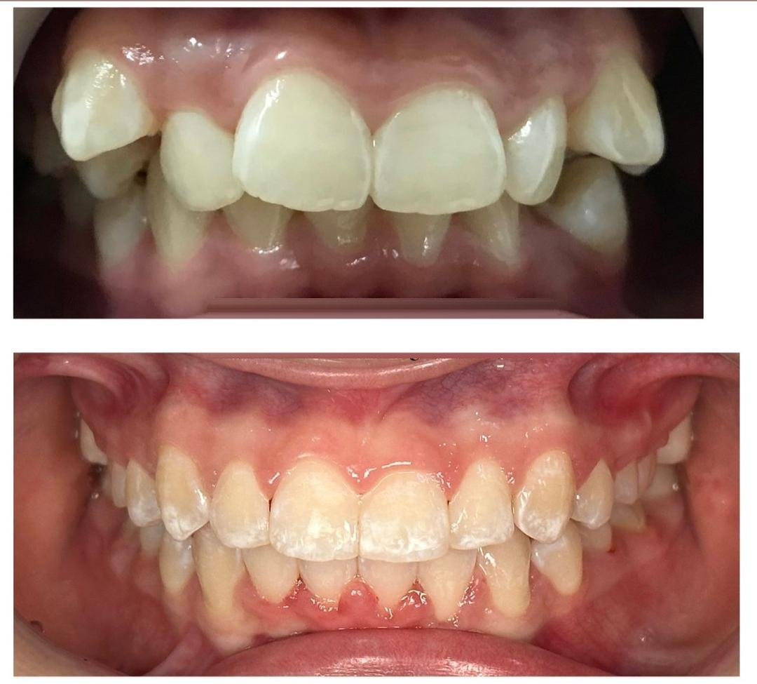 Braces / clear aligner before and after at Qualiteeth: crowded teeth aligned into a straight smile