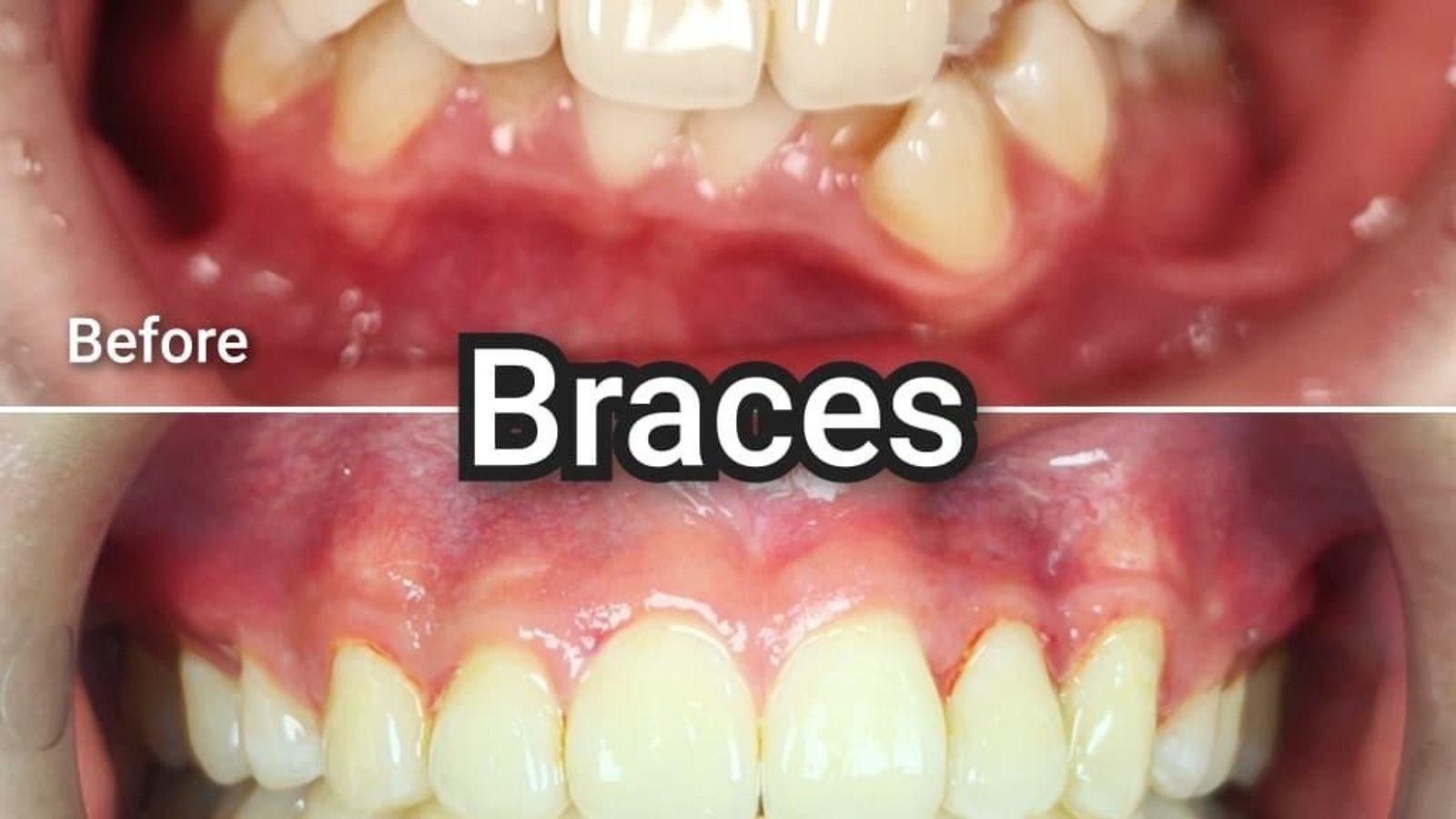 Braces / clear aligner before and after at Qualiteeth: crowded teeth straightened