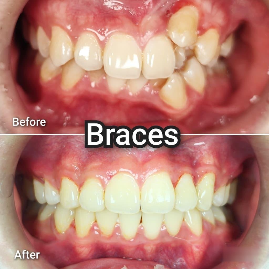 Braces before and after at Qualiteeth: crowded teeth straightened
