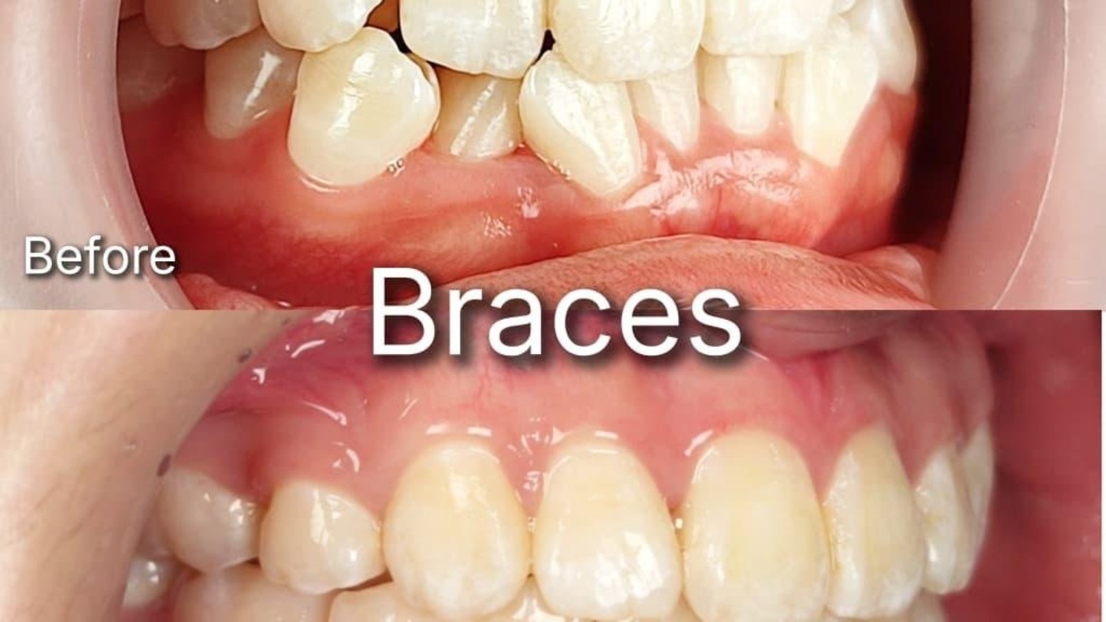 Braces / clear aligner before and after at Qualiteeth: crowded front teeth aligned