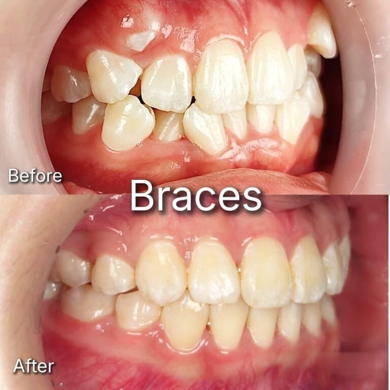 Braces before and after at Qualiteeth: crowded front teeth aligned