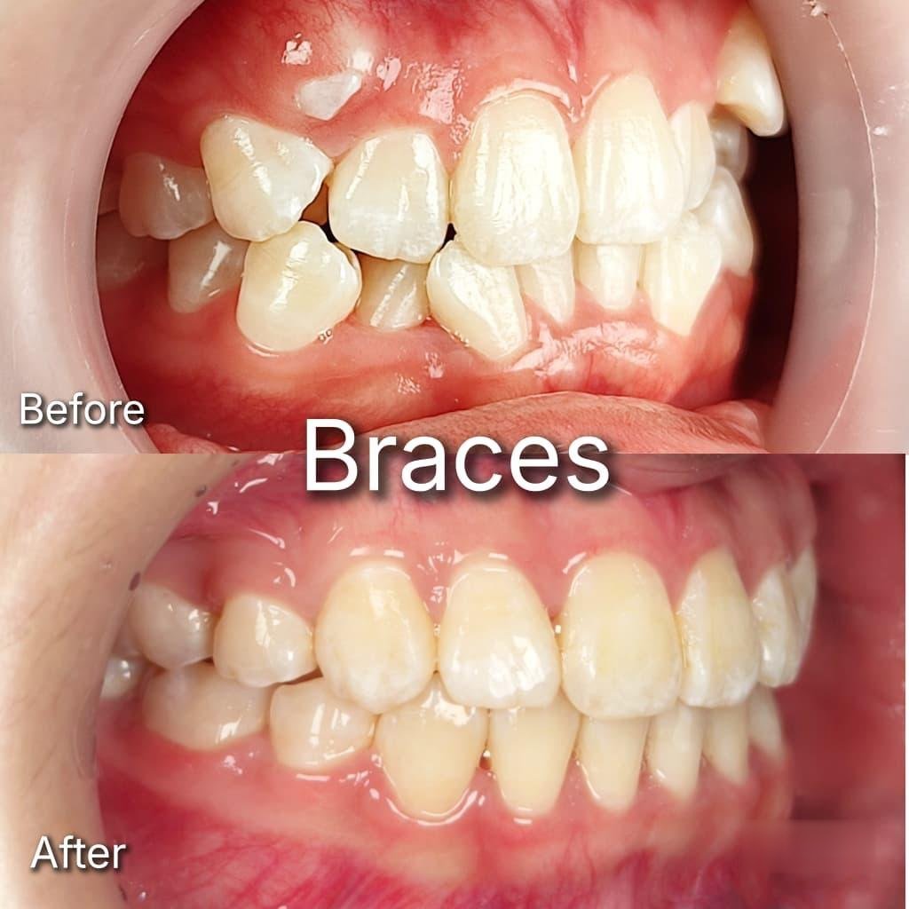 Sebelum dan selepas braces di Qualiteeth: gigi depan bertindih disusun semula