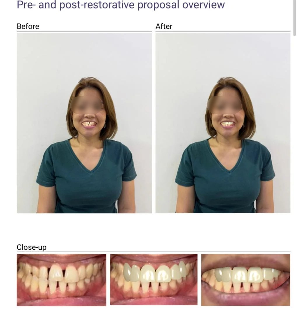Digital smile design proposal showing the planned smile before treatment, with close-ups of the teeth