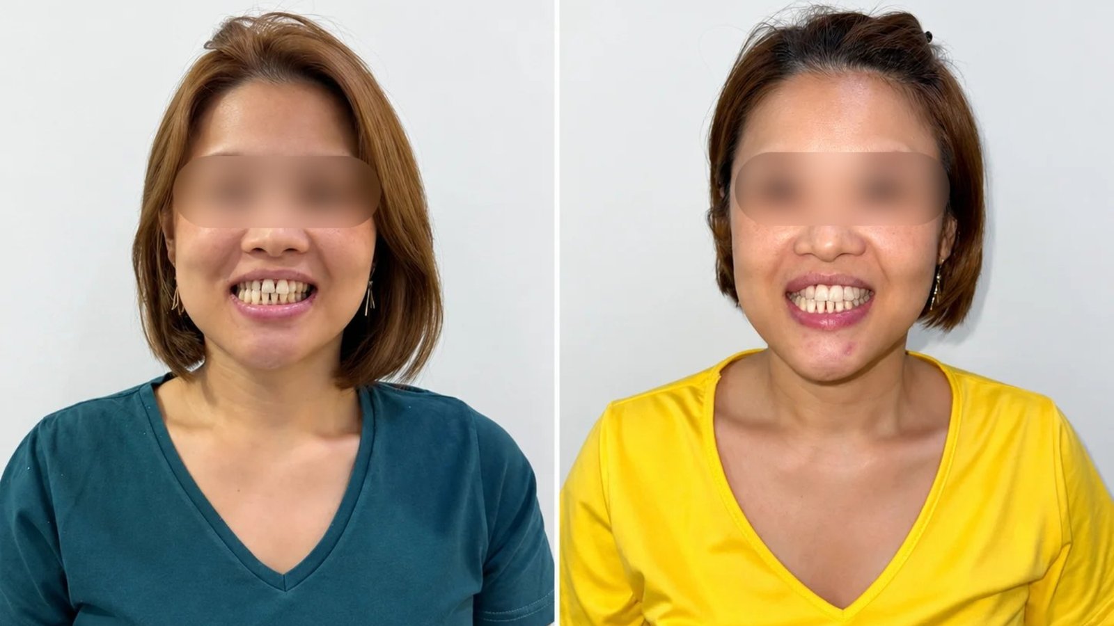 Smile makeover with digital smile design and veneers, before and after