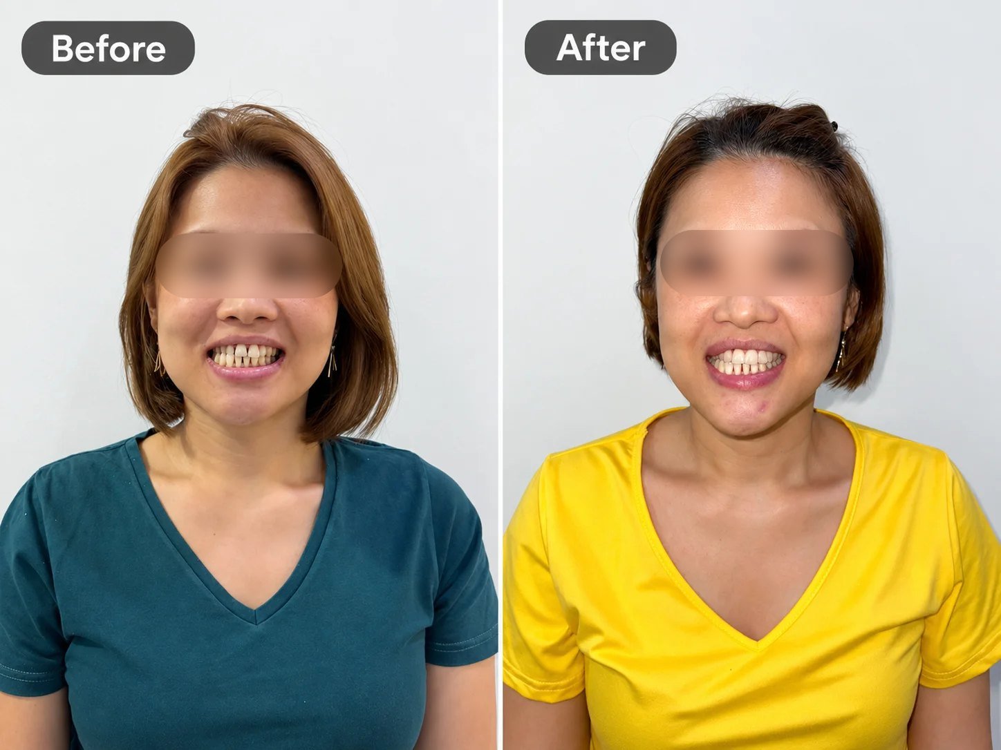 Smile makeover with digital smile design and veneers, before and after