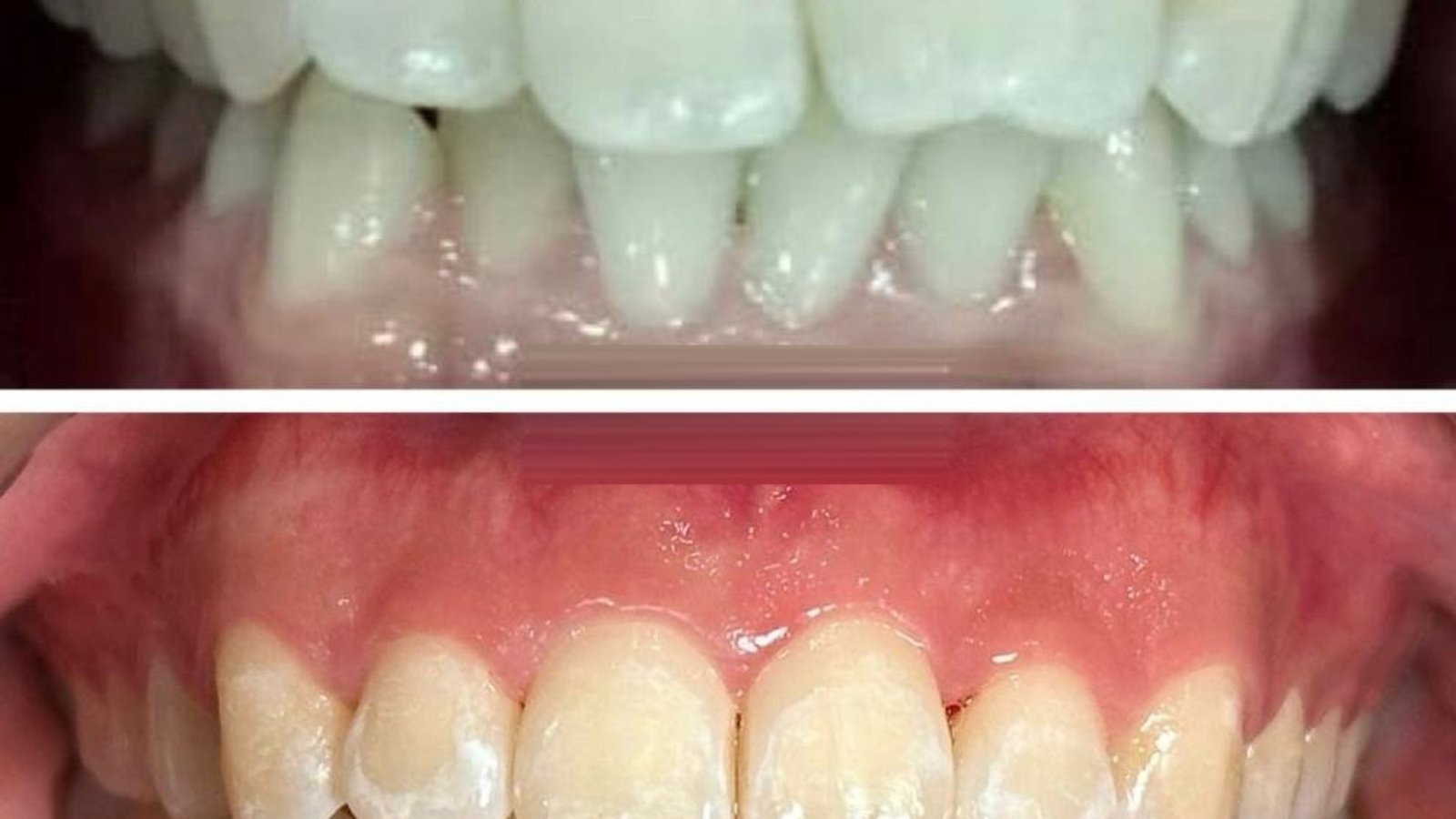 Braces / clear aligner before and after at Qualiteeth: teeth straightened