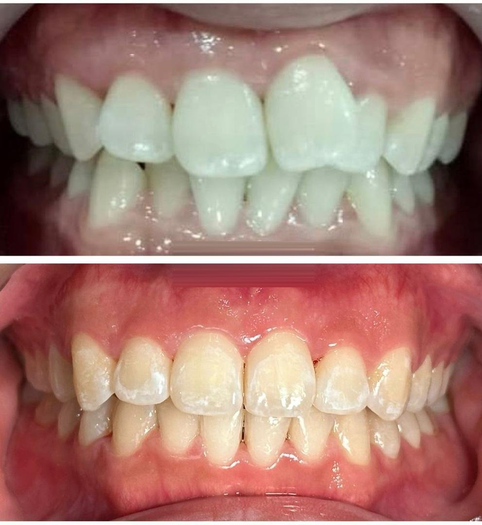 Braces before and after at Qualiteeth: teeth straightened