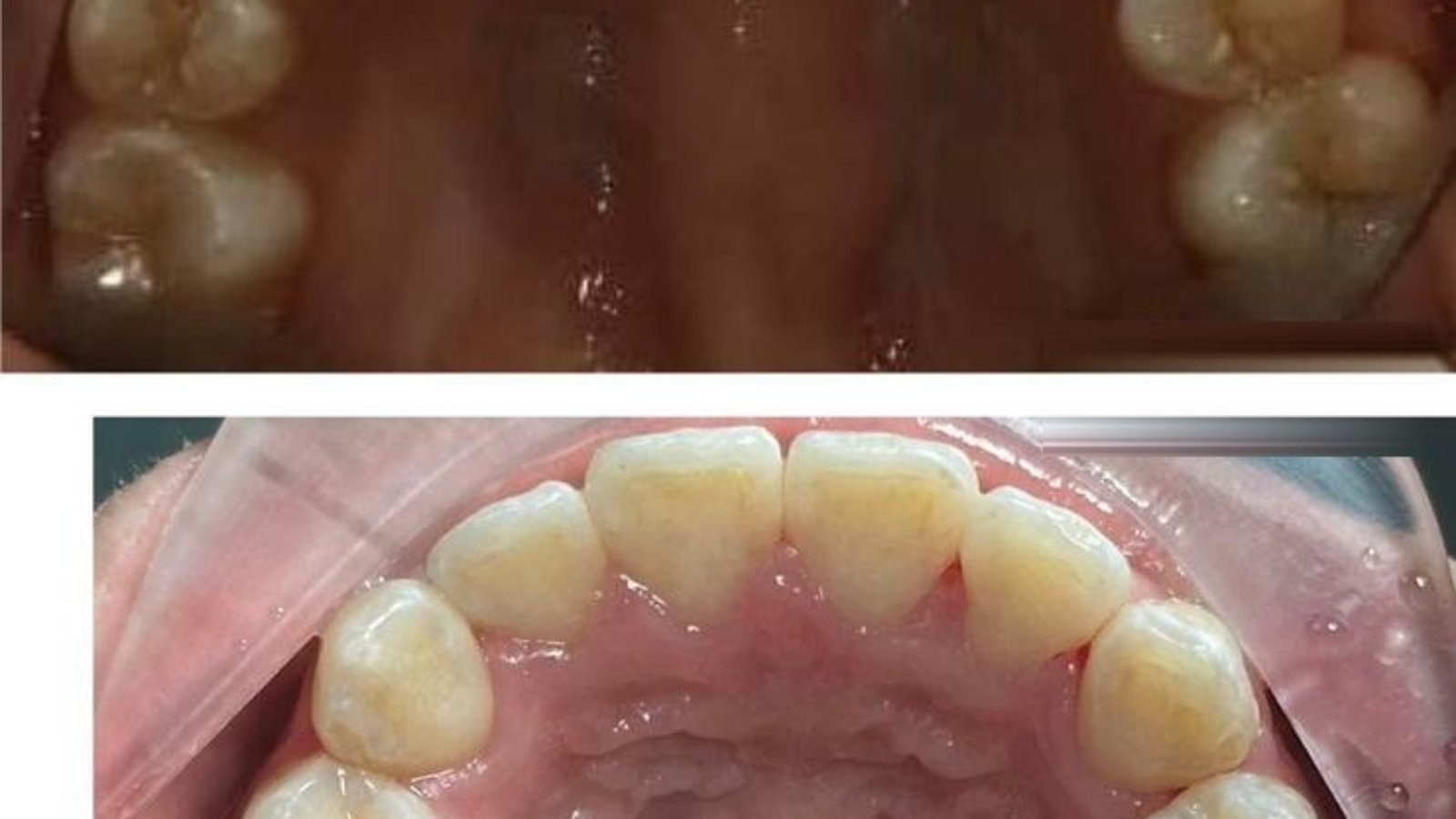 Braces / clear aligner before and after at Qualiteeth: upper arch aligned