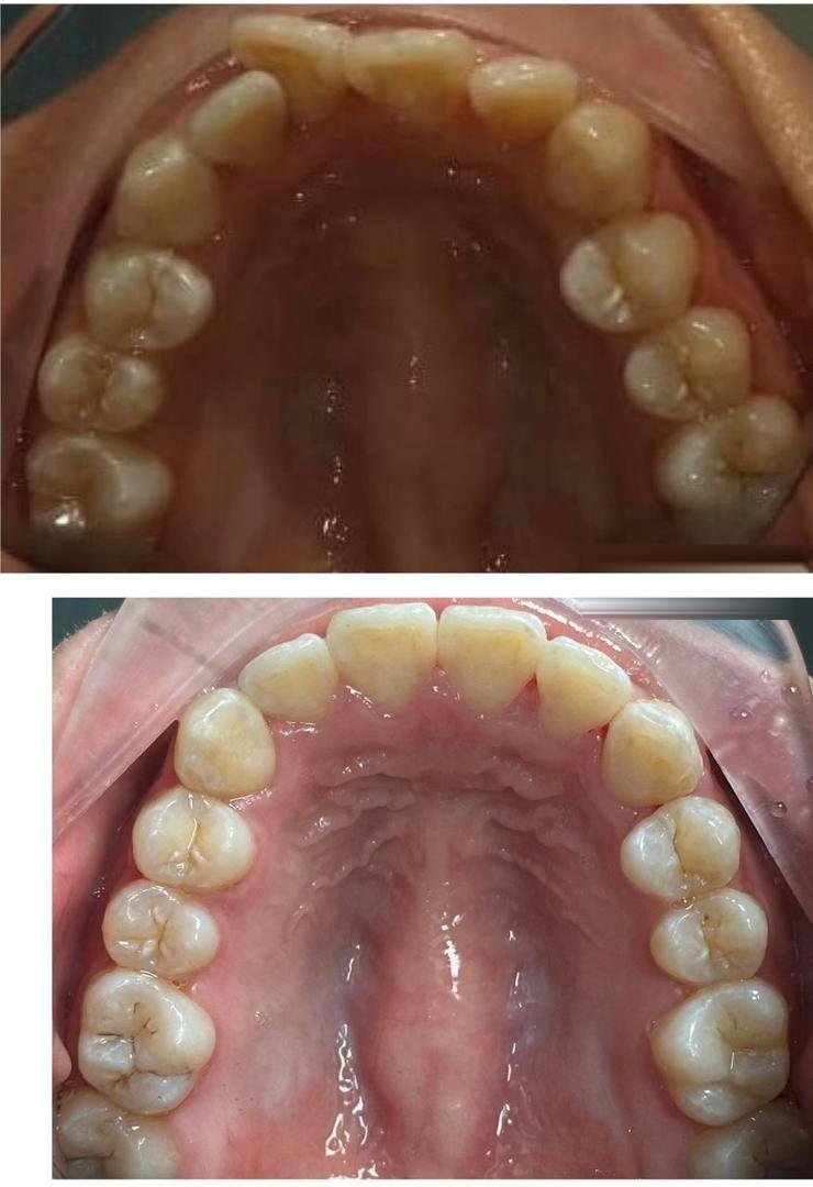 Braces dewasa di selayang: Sebelum dan selepas braces di Qualiteeth: gigi atas disusun semula